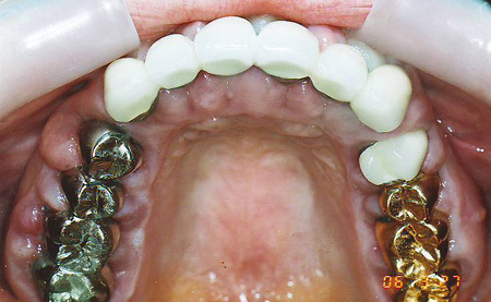 被せ物の不具合による歯周病・歯槽膿漏 - 小田原の歯周病・歯槽膿漏 