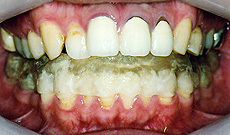 顎関節症 治療例 1 小田原の歯周病 歯槽膿漏治療室 天野歯科医院